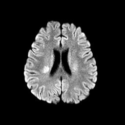 MRI Brain DWI